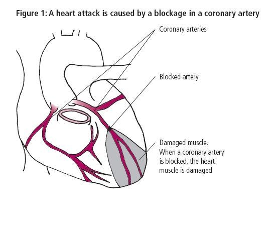 poza despre infarctul miocardic acut